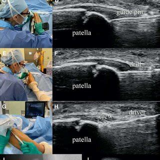Ultrasound Probe Maneuvers के लिए छवि परिणाम