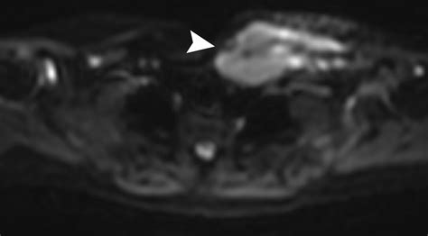 Image result for Multiple Myeloma Imaging