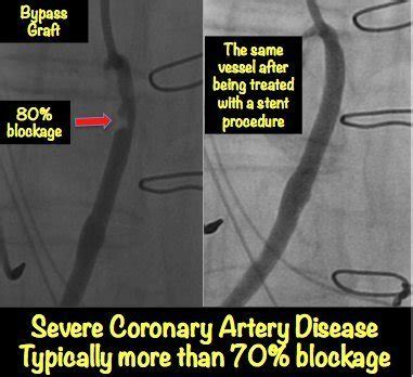 Image result for Angiogram Haert Test Blockage