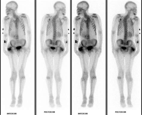 Toradh íomhá ar Radionuclide Bone Scan