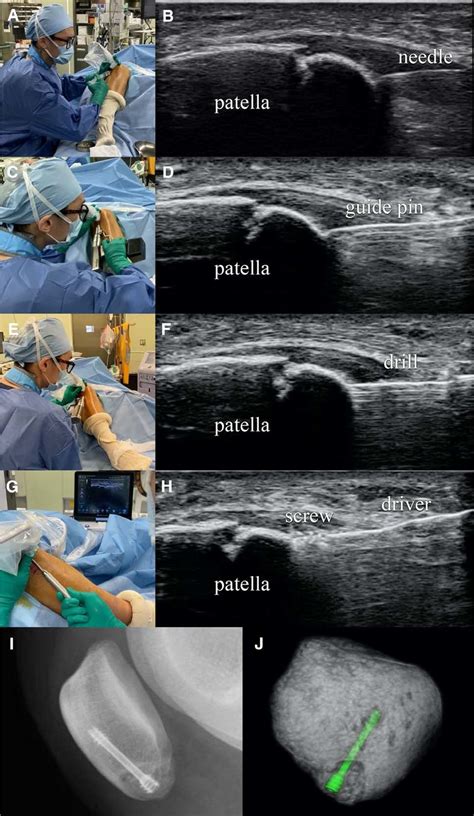 Ultrasound Probe Maneuvers के लिए छवि परिणाम