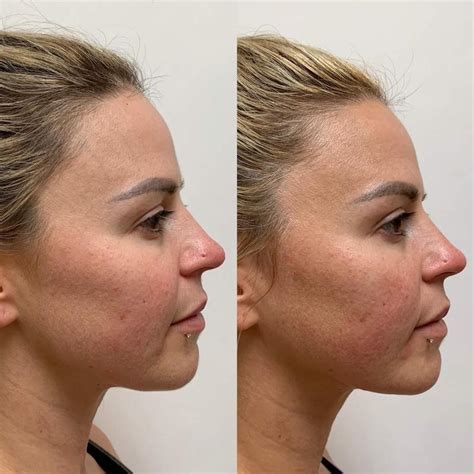 Spring Thread Lift Before and After に対する画像結果