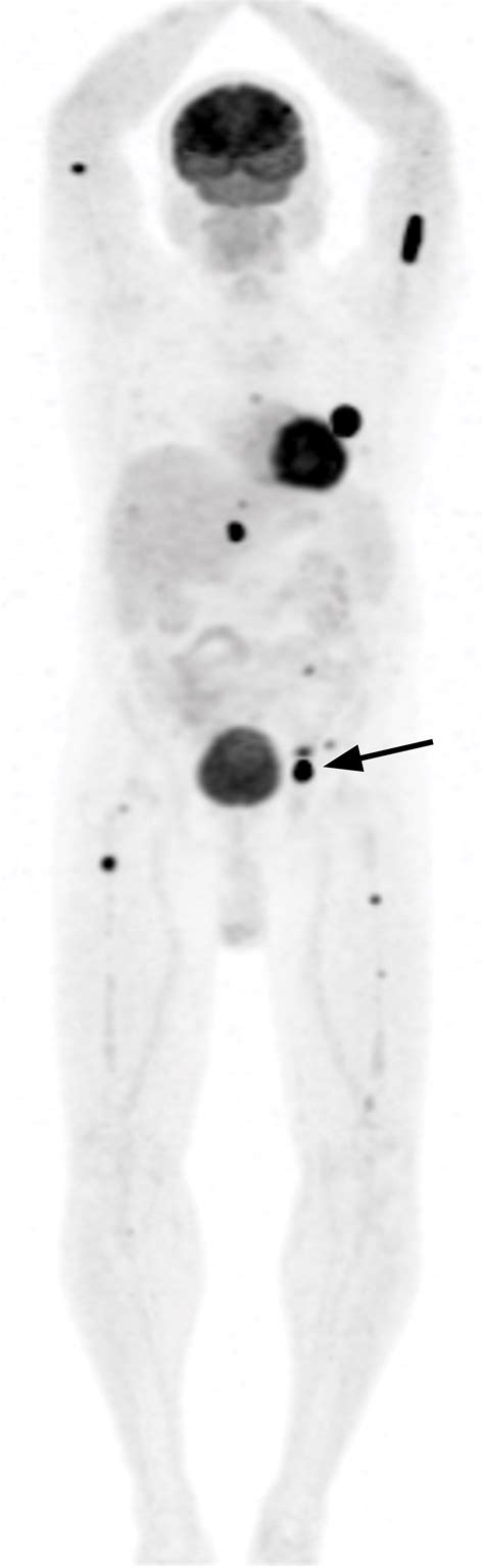Image result for Multiple Myeloma Imaging