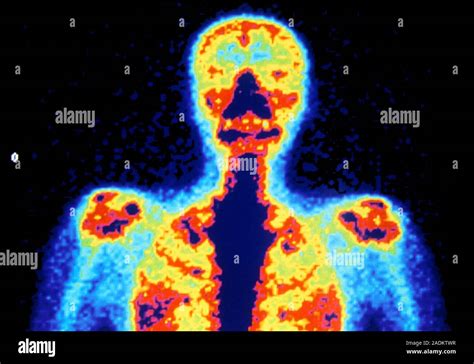 Toradh íomhá ar Radionuclide Bone Scan