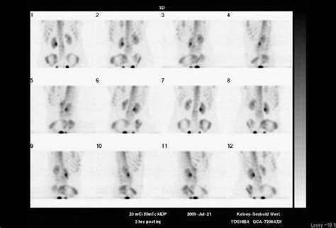 Toradh íomhá ar Radionuclide Bone Scan