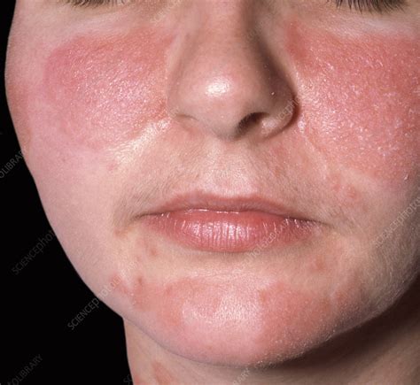 Image result for Sebaceous Dermatitis