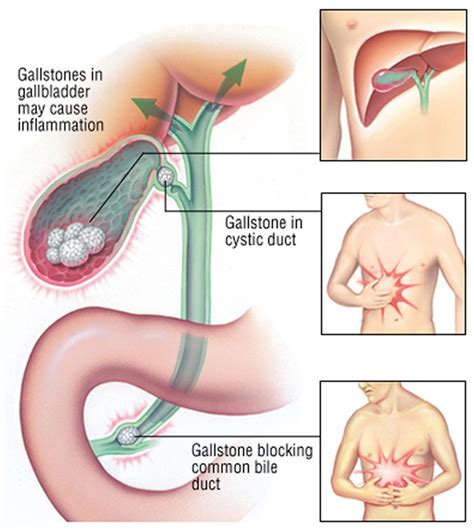 Image result for Sore Gallbladder