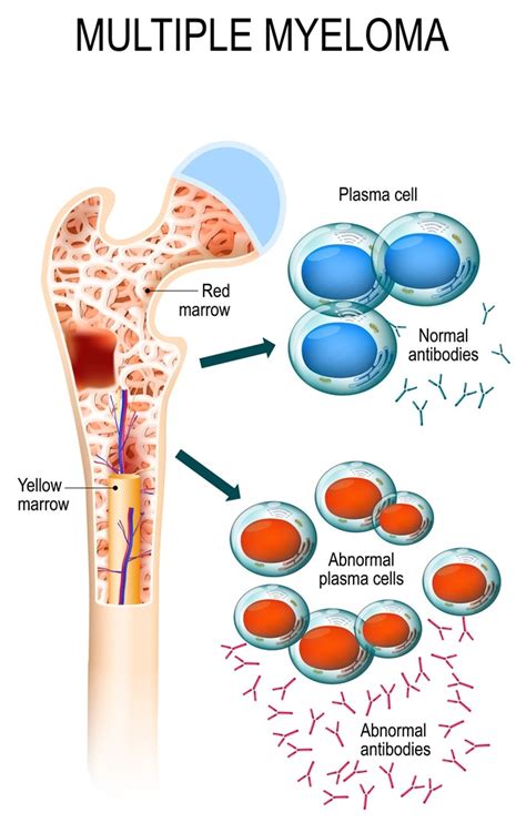 Image result for Flame Cells Multiple Myeloma