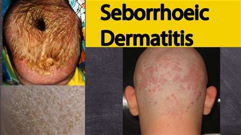 Image result for Sebaceous Dermatitis