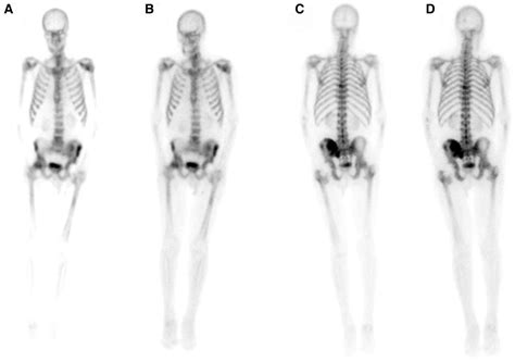 Toradh íomhá ar Radionuclide Bone Scan