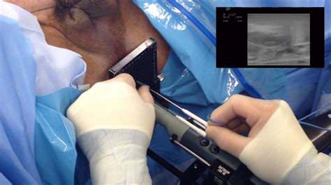 Image result for Prostate Manipulation Procedure