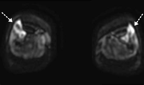 Image result for Multiple Myeloma Imaging