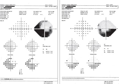 Image result for Aion Visual Field