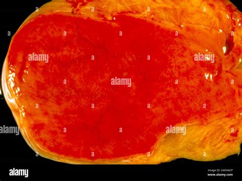 Image result for Gallbladder Skin Rash