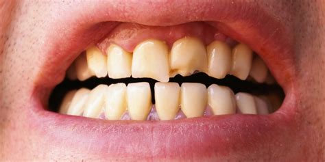 Afbeeldingsresultaten voor Chipped Tooth
