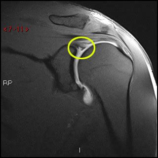 Toradh íomhá ar Labrum Shoulder MRI