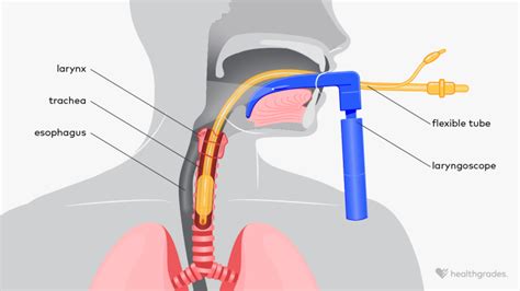 Image result for Different Types of Intubation