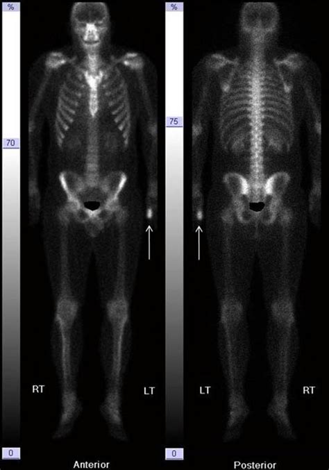 Toradh íomhá ar Radionuclide Bone Scan