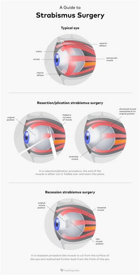 Image result for Strabismus Surgery