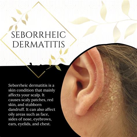 Image result for Sebaceous Dermatitis