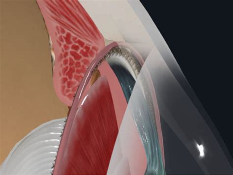 Image result for Over Clock Limbus