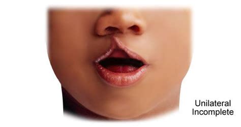 Image result for Palatoschisis Types