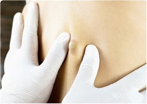 Afbeeldingsresultaten voor Deep Back Cysts