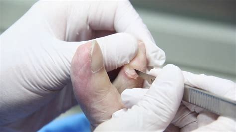 Toradh íomhá ar How to Remove Corns