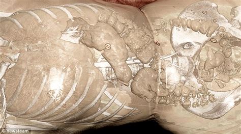 Human Body Post-Mortem ಗಾಗಿ ಇಮೇಜ್ ಫಲಿತಾಂಶ