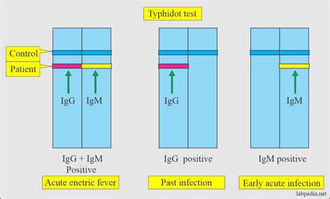 Toradh íomhá ar Widal Lab Test