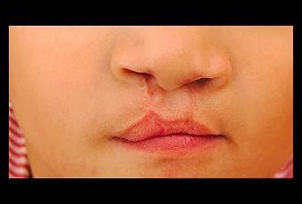 Image result for Palatoschisis Types