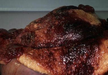 Human Body Post-Mortem ಗಾಗಿ ಇಮೇಜ್ ಫಲಿತಾಂಶ