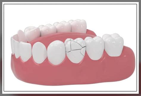 Image result for Cracked Tooth From Chewing Ice