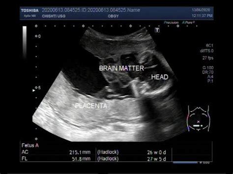 Image result for Anencephaly 8 Week Ultrasound
