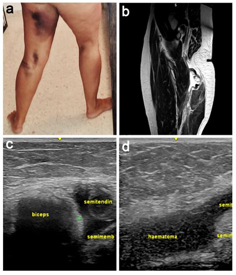 Image result for Lower Hamstring Tear Injection