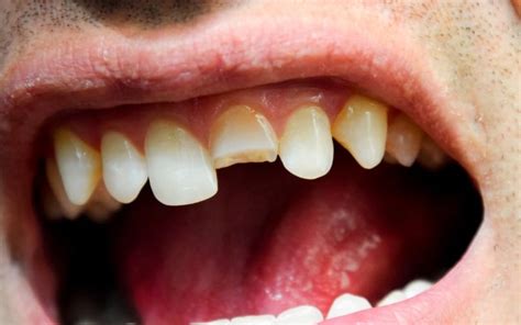 First Tooth Taken Out に対する画像結果