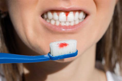 Afbeeldingsresultaten voor Bleeding around Tooth