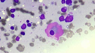 Image result for Flame Cells Multiple Myeloma