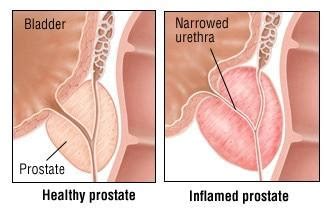 Prostate Laser Procedures に対する画像結果