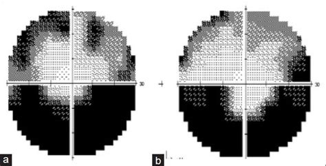 Image result for Aion Visual Field