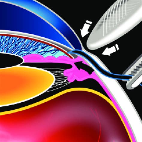 Image result for Over Clock Limbus