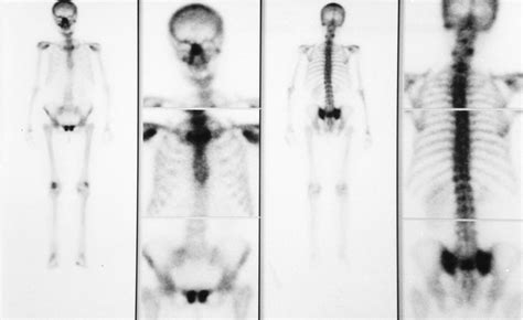Toradh íomhá ar Radionuclide Bone Scan