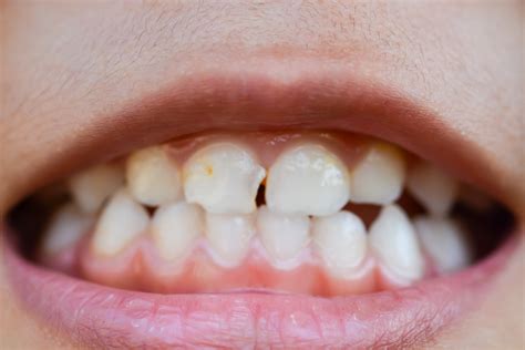 Image result for Cracked Tooth From Chewing Ice