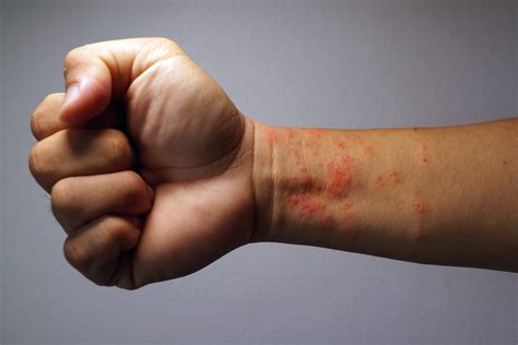 What Does Eczema Look Like に対する画像結果