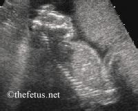 Image result for Anencephaly 8 Week Ultrasound