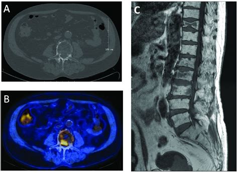 Image result for Multiple Myeloma Imaging