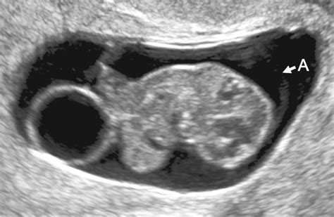 Image result for Anencephaly 8 Week Ultrasound