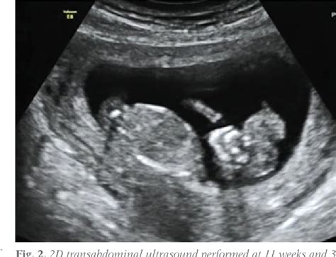 Image result for Anencephaly 8 Week Ultrasound