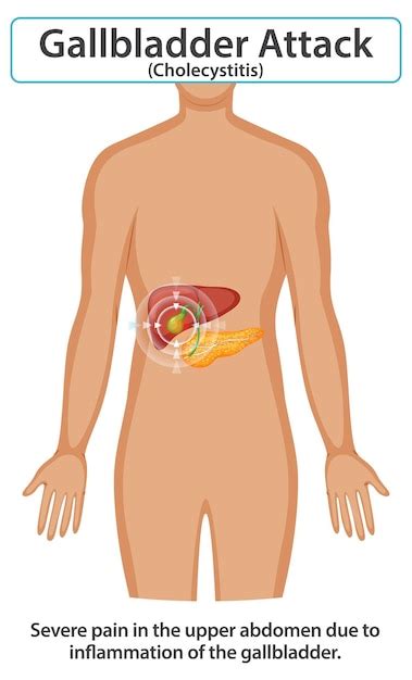 Image result for Sore Gallbladder