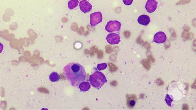 Image result for Flame Cells Multiple Myeloma